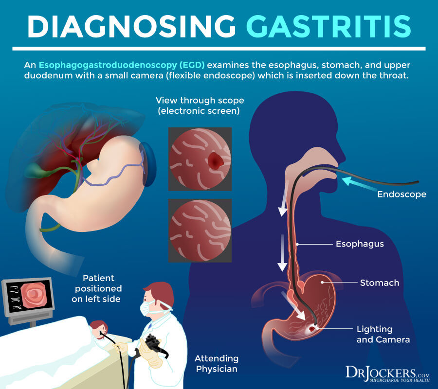 gastritis