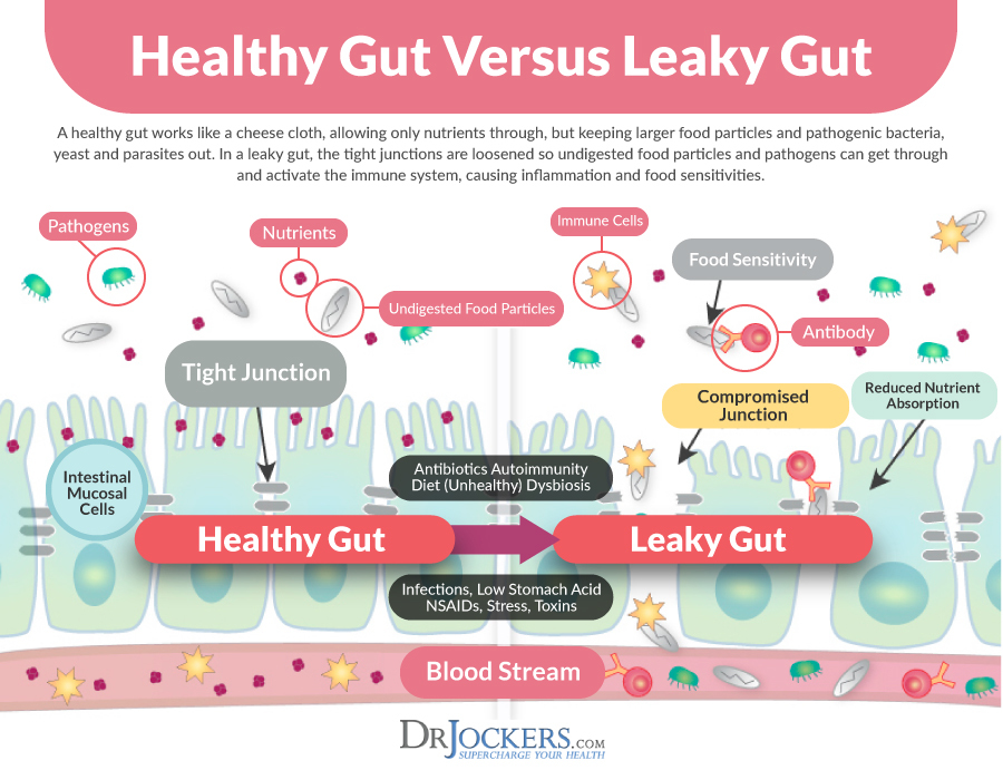 intestinal permeability, Intestinal Permeability, Histamine, and Leaky Gut Functional Lab Markers