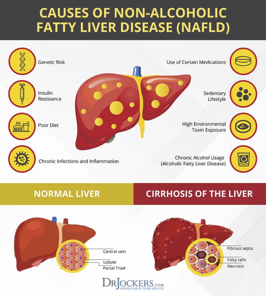 fatty liver