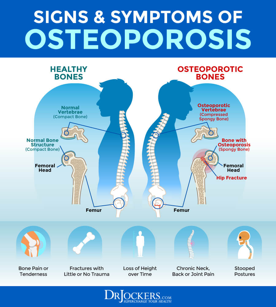 Osteoporosis, Osteoporosis: Symptoms, Causes and Natural Support Strategies