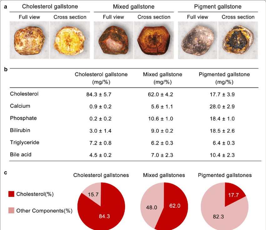 gallstones